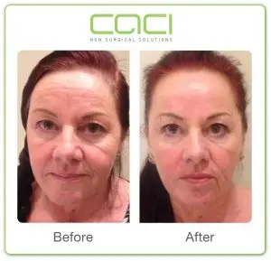 Before-and-After-CACI